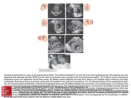 Occipital encephalocele in a fetus at 34 postmenstrual weeks