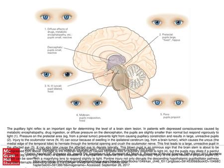 The pupillary light reflex is an important sign for determining the level of a brain stem lesion. In patients with depressed consciousness caused by metabolic.