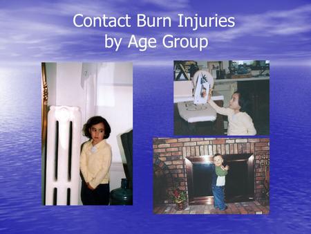 Contact Burn Injuries by Age Group. Candle-Related Incidents Residential Fires Involving Candles 1993 – 1995 Fires: 7,600 Deaths: 80 Injuries: 840 Estimated.