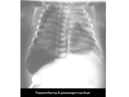 Pneumothorax & pneumopericardium