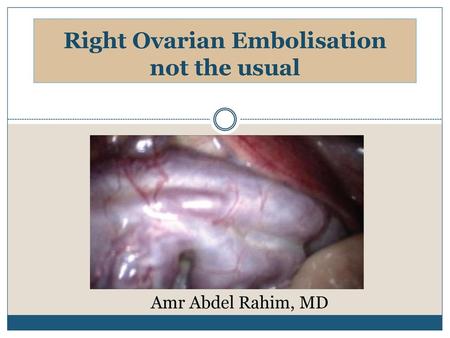Right Ovarian Embolisation not the usual