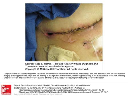 Surgical incision on a transplant patient The patient on antirejection medications (Prednisone and Cellcept) after liver transplant. Note the poor epithelial.