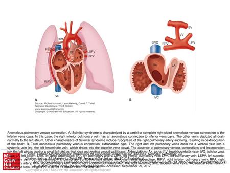 Anomalous pulmonary venous connection. A