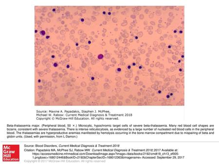 Beta-thalassemia major. (Peripheral blood, 50 ×