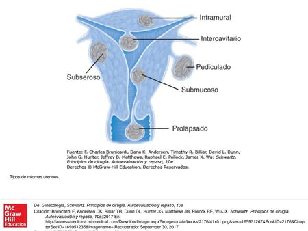 Tipos de miomas uterinos.