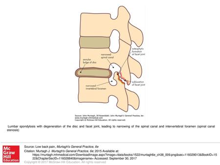 Lumbar spondylosis with degeneration of the disc and facet joint, leading to narrowing of the spinal canal and intervertebral foramen (spinal canal stenosis)