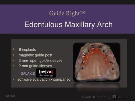 Guide Right™ Edentulous Maxillary Arch