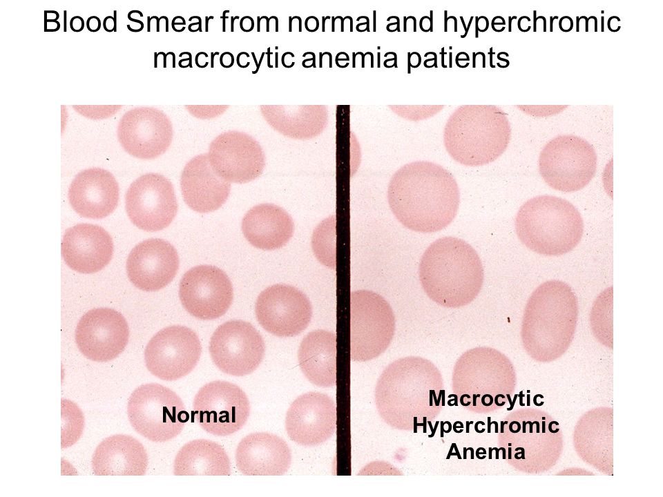 Image result for macrocytic anemia