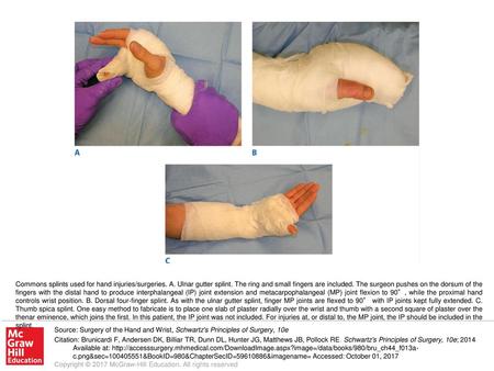 Commons splints used for hand injuries/surgeries. A