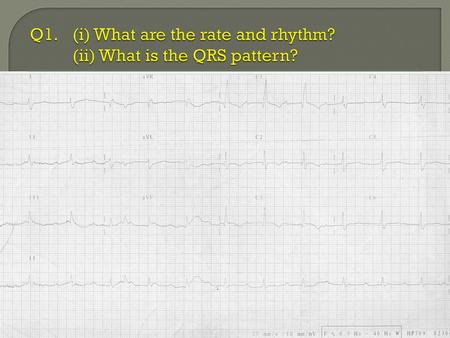 Q1. (i) What are the rate and rhythm? (ii) What is the QRS pattern?