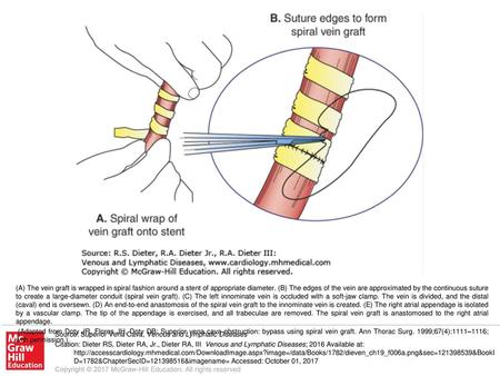 (Adapted from Doty JR, Flores JH, Doty DB: Superior vena cava obstruction: bypass using spiral vein graft. Ann Thorac Surg. 1999;67(4):1111–1116; with.