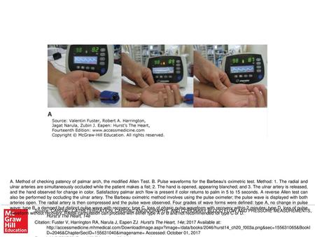 A. Method of checking patency of palmar arch, the modified Allen Test