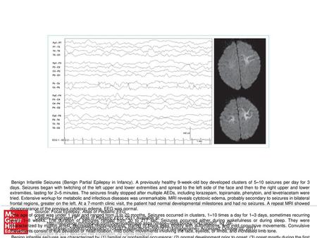 Benign infantile seizures are characterized by (1) familial or nonfamilial occurrence; (2) normal development prior to onset; (3) onset mostly during the.