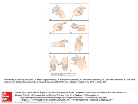 Deformities of the wrist and hand. A. Mallet finger deformity. B