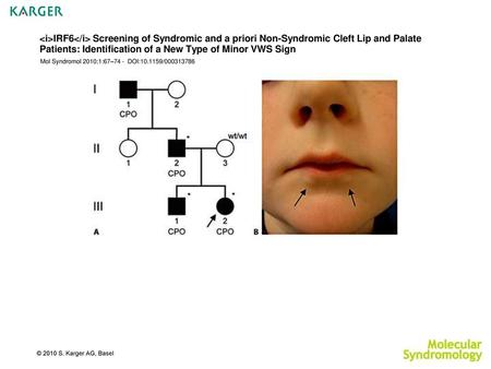 IRF6 Screening of Syndromic and a priori Non-Syndromic Cleft Lip and Palate Patients: Identification of a New Type of Minor VWS Sign Mol Syndromol.