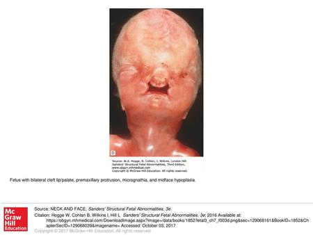 Fetus with bilateral cleft lip/palate, premaxillary protrusion, micrognathia, and midface hypoplasia. Source: NECK AND FACE, Sanders' Structural Fetal.