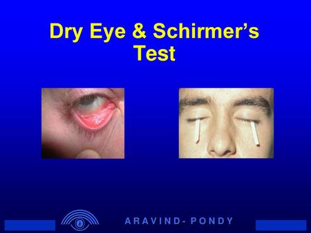 Dry Eye & Schirmer’s Test