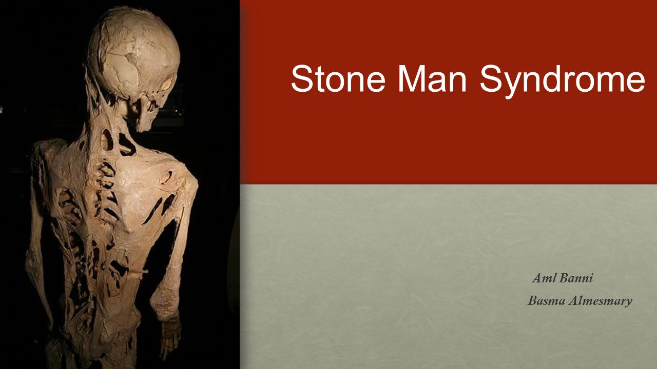 Stone Man Syndrome