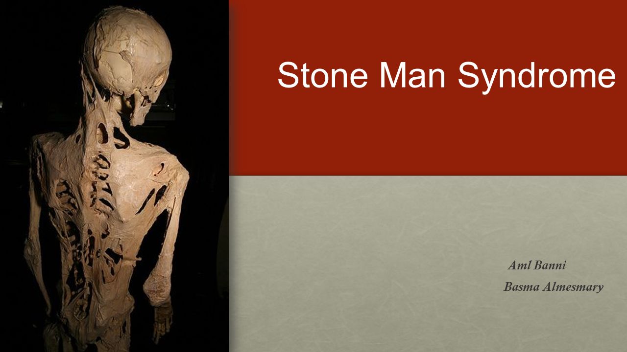 stone man syndrome