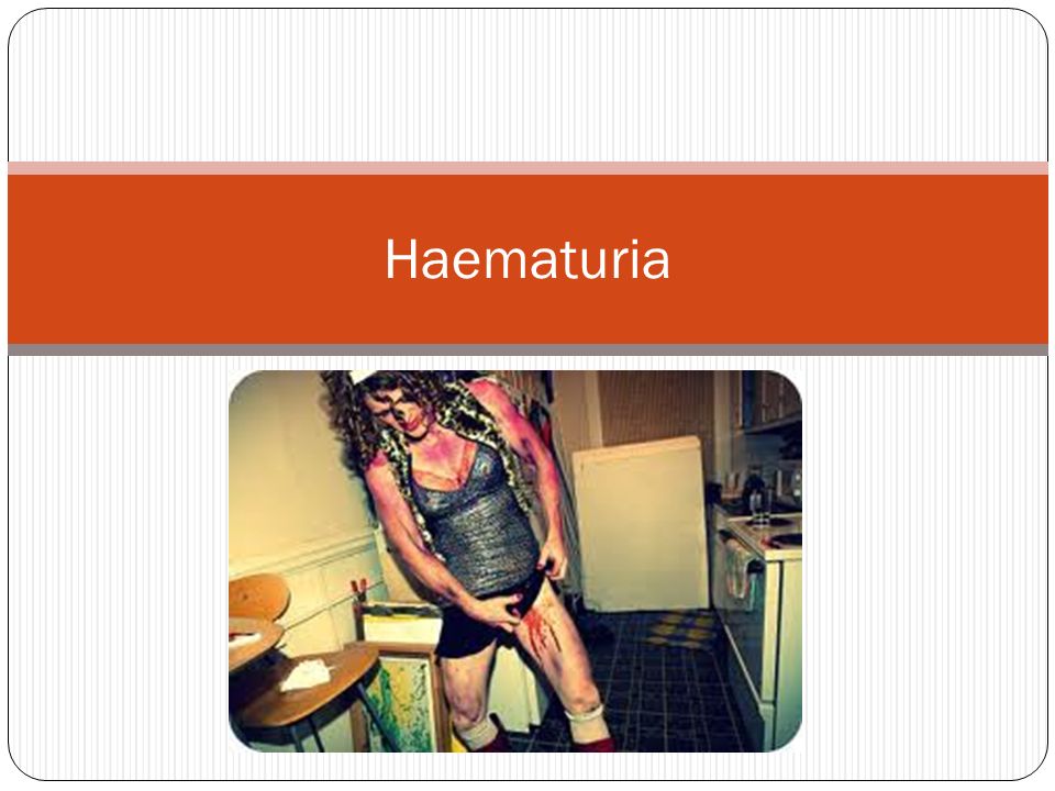 Haematuria. History The passage of clots in urine is indicative of