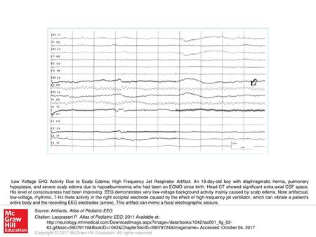 Low Voltage EKG Activity Due to Scalp Edema; High Frequency Jet Respirator Artifact. An 18-day-old boy with diaphragmatic hernia, pulmonary hypoplasia,