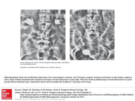 Nephroduodenal fistula and small-bowel obstruction from renal staghorn calculus. Left: Excretory urogram showing nonfunction of right kidney; staghorn.