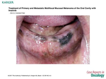 Treatment of Primary and Metastatic Multifocal Mucosal Melanoma of the Oral Cavity with Imatinib - DOI:10.1159/000477563 Fig. 1. Multiple, partially confluent,