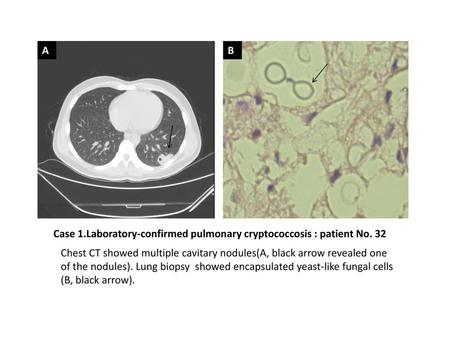 A B Case 1.Laboratory-confirmed pulmonary cryptococcosis : patient No. 32 Chest CT showed multiple cavitary nodules(A, black arrow revealed one of the.
