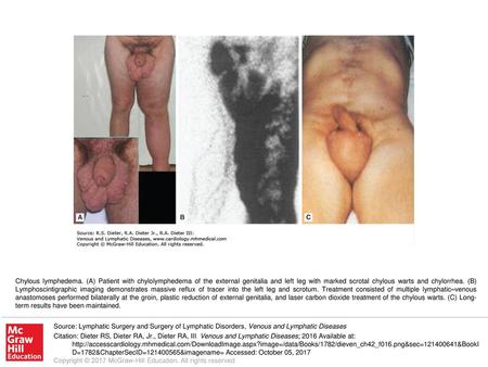 Chylous lymphedema. (A) Patient with chylolymphedema of the external genitalia and left leg with marked scrotal chylous warts and chylorrhea. (B) Lymphoscintigraphic.