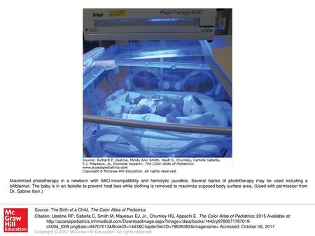 Maximized phototherapy in a newborn with ABO-incompatibility and hemolytic jaundice. Several banks of phototherapy may be used including a biliblanket.