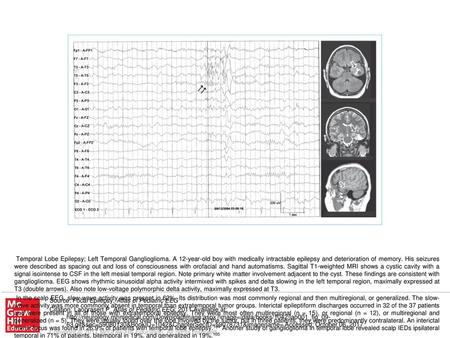 In the scalp EEG, slow-wave activity was present in 62%