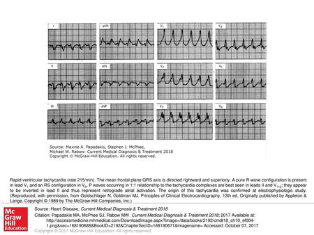 Rapid ventricular tachycardia (rate 215/min)