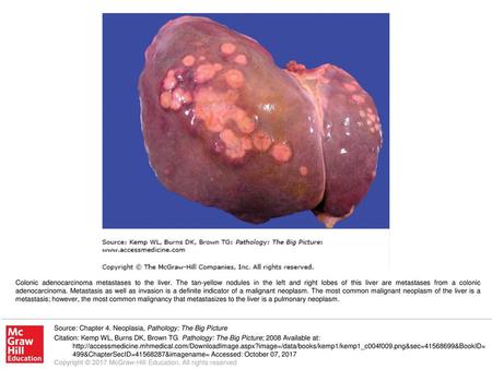 Colonic adenocarcinoma metastases to the liver