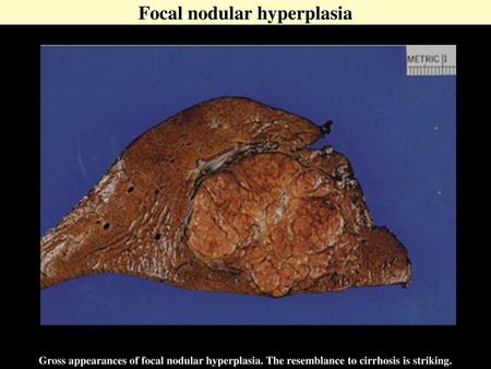 Focal nodular hyperplasia