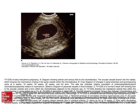 TV-CDS of early intrauterine pregnancy