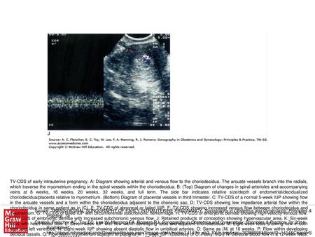 TV-CDS of early intrauterine pregnancy