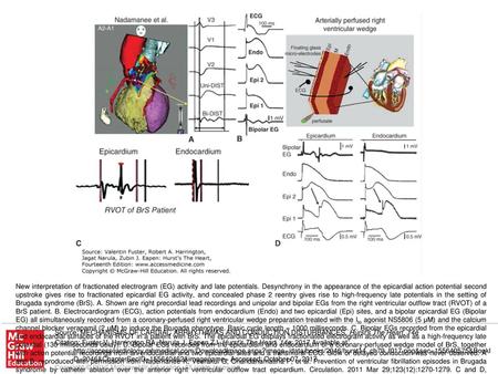 New interpretation of fractionated electrogram (EG) activity and late potentials. Desynchrony in the appearance of the epicardial action potential second.