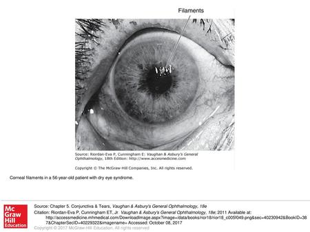 Corneal filaments in a 56-year-old patient with dry eye syndrome.