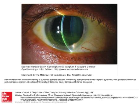 Demonstration with fluorescein staining of punctuate epithelial erosions found in dry eye syndrome due to Sjogren's syndrome, with greater distribution.