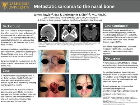 Metastatic sarcoma to the nasal bone