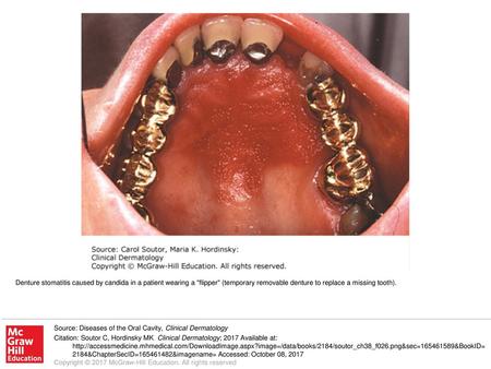 Denture stomatitis caused by candida in a patient wearing a flipper (temporary removable denture to replace a missing tooth). Source: Diseases of the.
