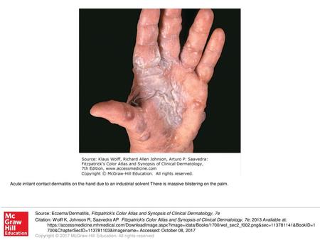 Acute irritant contact dermatitis on the hand due to an industrial solvent There is massive blistering on the palm. Source: Eczema/Dermatitis, Fitzpatrick's.