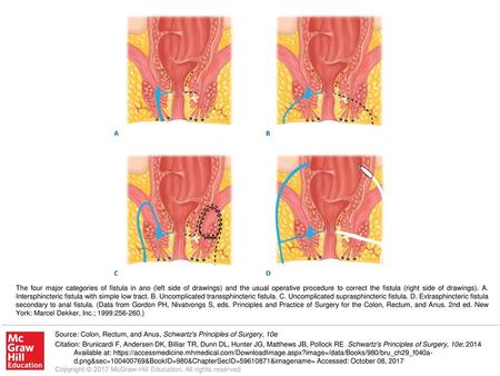 The four major categories of fistula in ano (left side of drawings) and the usual operative procedure to correct the fistula (right side of drawings).