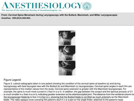 From: Cervical Spine Movement during Laryngoscopy with the Bullard, Macintosh, and Miller Laryngoscopes Anesthes. 1995;82(4):859-869.. Figure Legend: Figure.