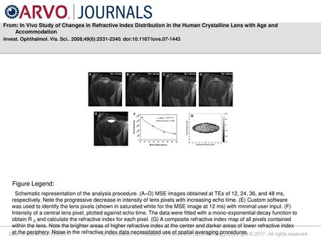 From: In Vivo Study of Changes in Refractive Index Distribution in the Human Crystalline Lens with Age and Accommodation Invest. Ophthalmol. Vis. Sci..