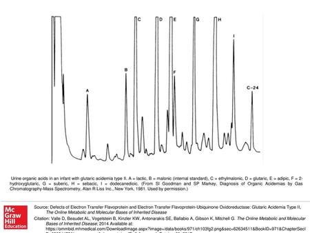Urine organic acids in an infant with glutaric acidemia type II
