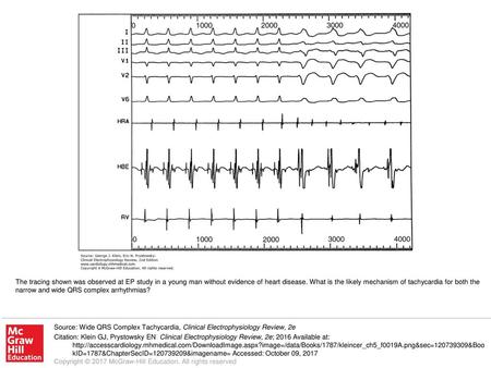 The tracing shown was observed at EP study in a young man without evidence of heart disease. What is the likely mechanism of tachycardia for both the narrow.