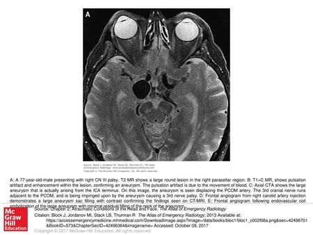 A: A 77-year-old-male presenting with right CN III palsy