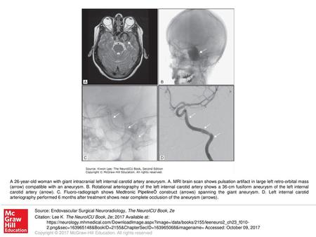 A 26-year-old woman with giant intracranial left internal carotid artery aneurysm. A. MRI brain scan shows pulsation artifact in large left retro-orbital.