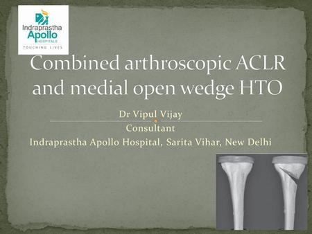 Combined arthroscopic ACLR and medial open wedge HTO